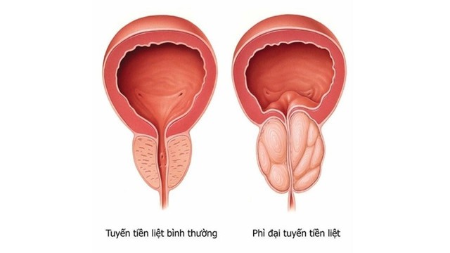 bai-viet/nguyen-nhan-gay-ra-phi-dai-tuyen-tien-liet-la-gi.html