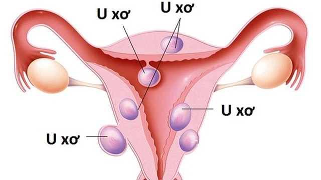 bai-viet/nguyen-nhan-gay-u-xo-tu-cung-va-cach-phong-tranh.html