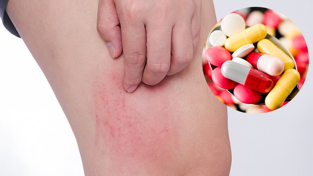 bai-viet/nhiem-doc-da-di-ung-thuoc-trieu-chung-va-phuong-phap-dieu-tri.html