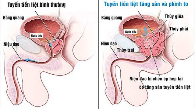 bai-viet/nhung-dieu-can-biet-ve-tang-san-lanh-tinh-tuyen-tien-liet.html