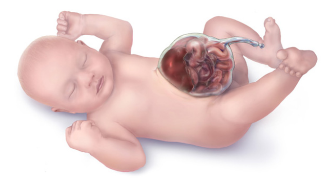 bai-viet/omphalocele-la-gi-anh-huong-cua-omphalocele-den-suc-khoe-va-su-phat-trien-cua-tre.html