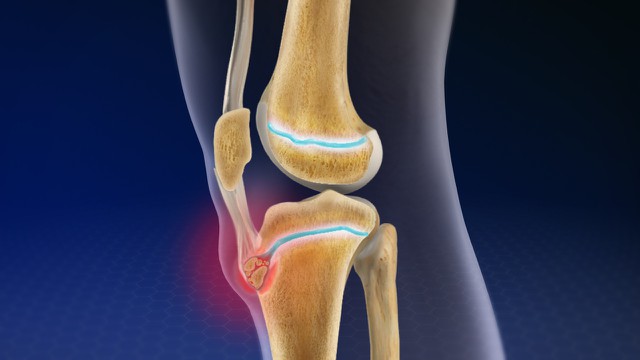 benh/benh-osgood-schlatter.html