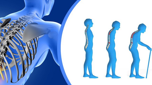 bai-viet/osteopenia-la-gi-nhung-dieu-ban-can-biet-ve-tinh-trang-osteopenia.html