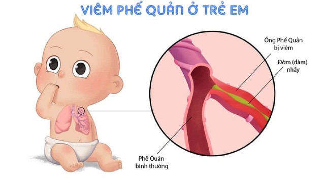 bai-viet/phac-do-dieu-tri-viem-phe-quan-o-tre-em-va-cach-cham-soc-tre-benh.html