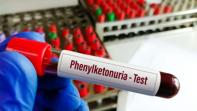 bai-viet/phenylketone-nieu-pku-nguyen-nhan-trieu-chung-va-dieu-tri.html