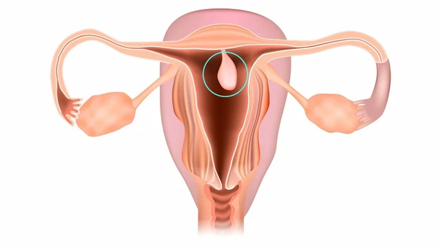 Polyp buồng tử cung