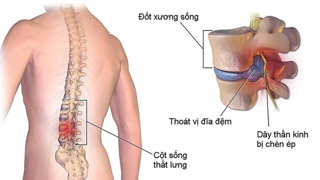 bai-viet/re-than-kinh-tuy-song-la-gi-dau-hieu-va-cach-dieu-tri-benh.html