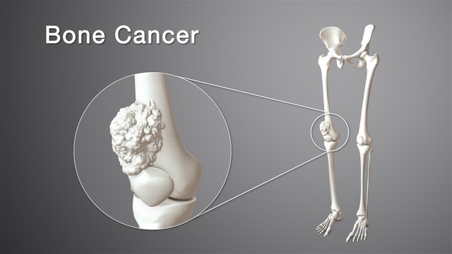 bai-viet/sarcoma-xuong-o-tre-em-la-benh-gi-62057.html