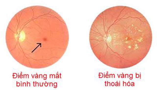 benh/thoai-hoa-diem-vang-399.html