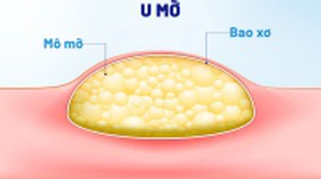 bai-viet/u-mo-o-bung-la-gi-co-nguy-hiem-khong.html