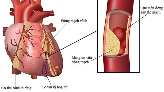 bai-viet/tac-dong-mach-vanh-nguyen-nhan-trieu-chung-va-cach-phong-ngua.html
