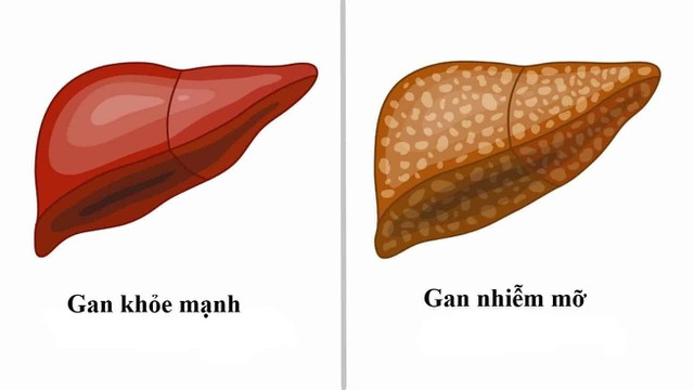 bai-viet/tac-hai-cua-gan-nhiem-mo-nguy-hiem-nhu-the-nao.html