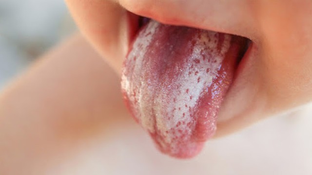 bai-viet/tai-sao-tre-bi-nam-vom-hong-nguyen-nhan-va-cach-chua-tri-56002.html