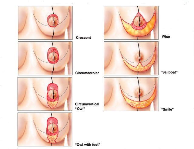 bai-viet/tat-tan-tat-nhung-thong-tin-can-biet-treo-sa-tre-bang-chi-70074.html