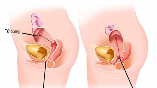 bai-viet/bi-loi-thit-o-vung-kin-khi-mang-thai-la-dau-hieu-cua-benh-gi-1.html
