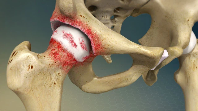Thoái hóa đa khớp là gì? Dấu hiệu nhận biết, điều trị và cách phòng ngừa thoái hóa đa khớp 1
