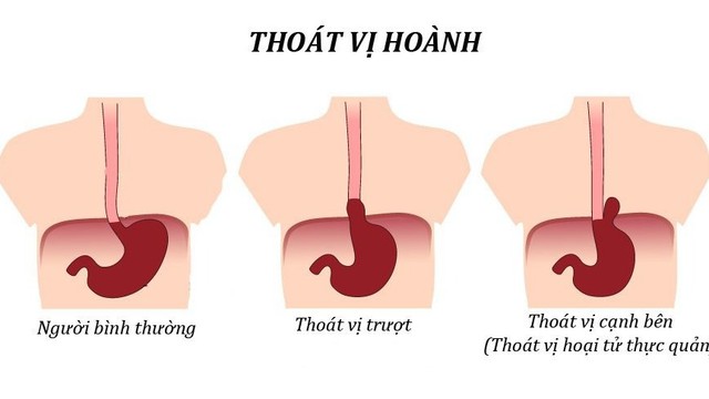 bai-viet/thoat-vi-hoanh-o-nguoi-lon-co-bieu-hien-gi.html