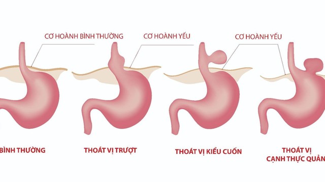 bai-viet/thoat-vi-khe-hoanh-la-gi-nguyen-nhan-va-cach-dieu-tri.html
