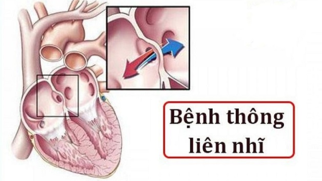 bai-viet/thong-lien-nhi-lo-thu-phat-co-nguy-hiem-khong.html