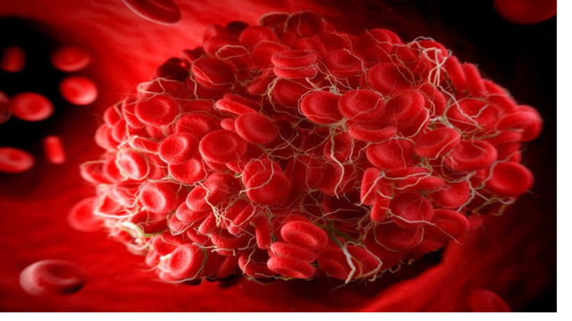 bai-viet/thrombophilia-nguyen-nhan-va-cach-phong-ngua-hieu-qua.html