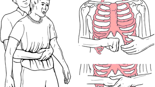 bai-viet/nghiem-phap-heimlich-la-gi-cach-thuc-hien.html