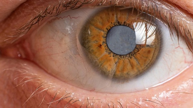 bai-viet/thuat-ngu-cataract-la-gi-nguoi-bi-mac-benh-cataract-co-nguy-hiem-khong.html