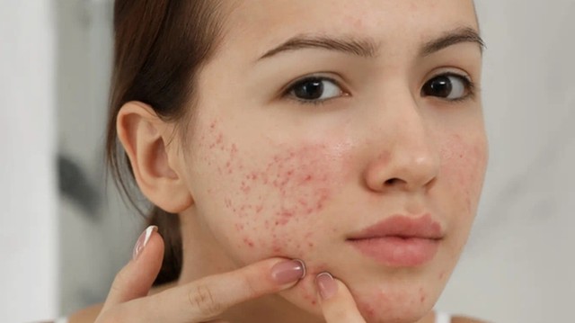 bai-viet/su-dung-kem-tri-mun-derma-forte-co-day-mun-khong.html