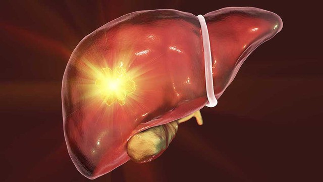 bai-viet/tim-hieu-benh-adenoma-gan-va-cach-phong-ngua-hieu-qua.html