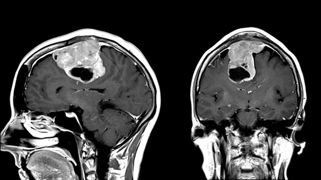 bai-viet/tim-hieu-ve-vai-tro-cua-chup-mri-u-mang-nao-trong-chan-doan-benh.html