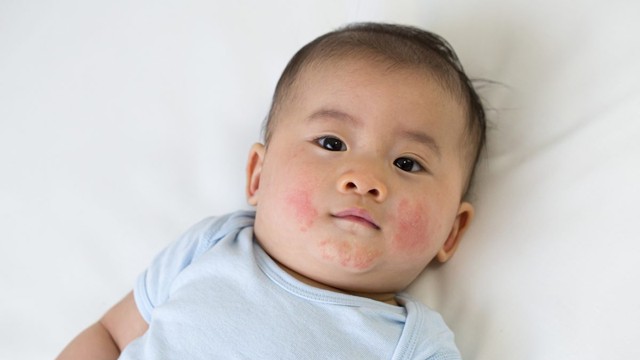 bai-viet/tre-so-sinh-bi-hac-lao-o-mat-la-do-dau-va-khac-phuc-nhu-the-nao-55611.html