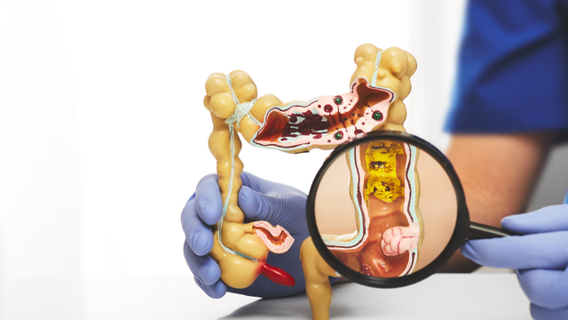 bai-viet/trieu-chung-sau-khi-cat-polyp-dai-trang.html