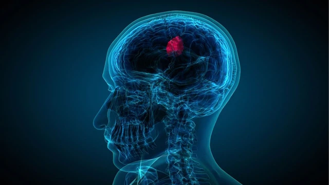 U tiểu não: Triệu chứng nhận biết, phác đồ điều trị và tiên lượng bệnh