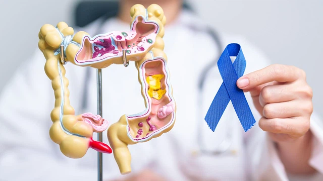  Ung thư đại trực tràng là bệnh gì? Có thể phòng ngừa hay không? 1