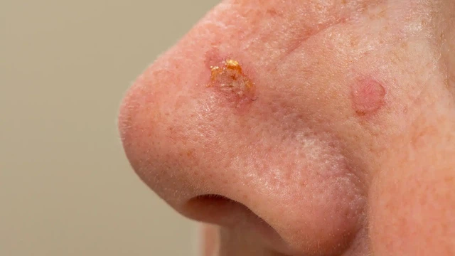 Ung thư tế bào vảy là gì? Triệu chứng, nguyên nhân, chẩn đoán và điều trị bệnh 3