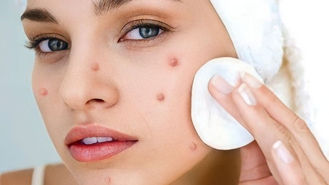 bai-viet/uong-acnotin-bao-lau-thi-het-mun-nhung-thac-mac-hay-gap-khi-su-dung-acnotin.html