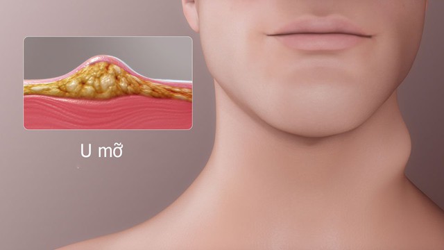 bai-viet/uong-gi-de-tieu-u-mo-mot-so-nuoc-uong-giam-u-mo-hieu-qua.html