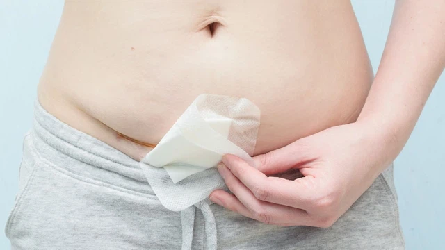 Vết mổ đẻ lần 2 bao lâu thì lành​? Cách giúp vết mổ đẻ nhanh lành