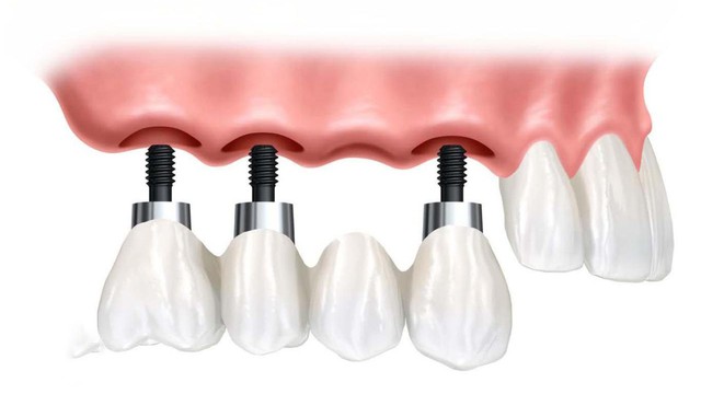 bai-viet/vi-sao-can-nang-xoang-kin-trong-cay-ghep-implant.html
