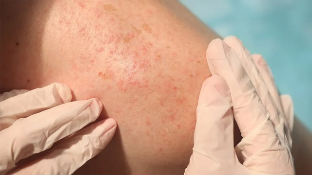 bai-viet/vi-sao-uong-thuoc-giai-doc-gan-bi-noi-mun.html