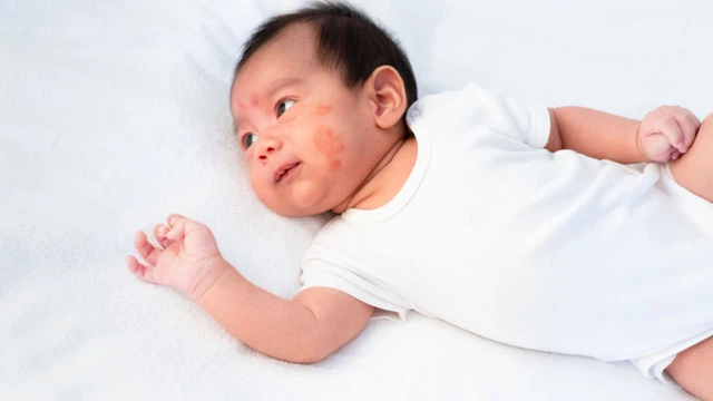 bai-viet/tim-hieu-chi-tiet-ve-benh-viem-da-tiep-xuc-o-tre.html
