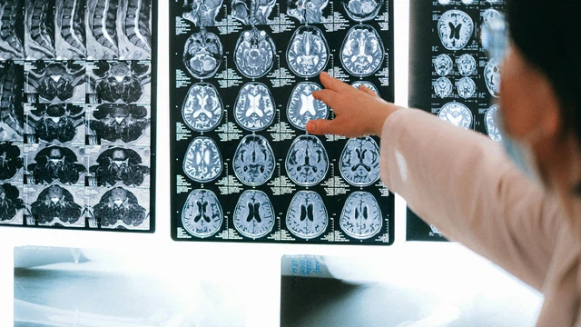 Viêm màng não mủ và viêm não mô cầu: Những mối nguy hiểm với hệ thần kinh 0