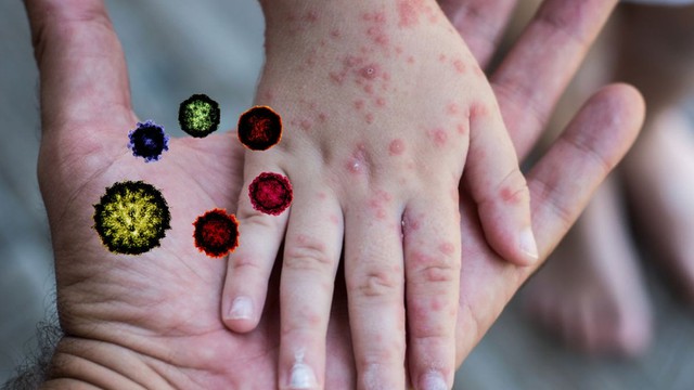 bai-viet/virus-coxsackie-a16-la-gi-gay-benh-gi-va-cach-phong-ngua-ra-sao.html