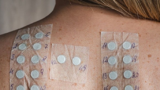 Xét nghiệm 91 dị nguyên: Cách phát hiện và điều trị dị ứng hiệu quả