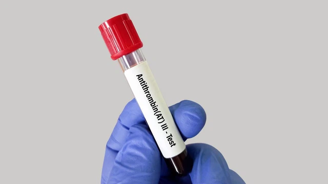 bai-viet/xet-nghiem-antithrombin-iii-va-nhung-thong-tin-quan-trong-can-biet.html