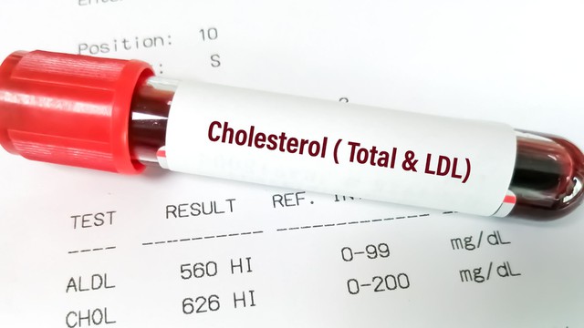 bai-viet/xet-nghiem-cholesterol-dinh-ky-giup-kiem-soat-mo-mau-hieu-qua.html