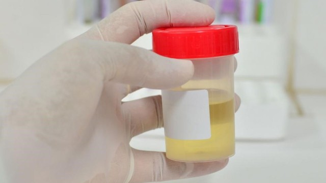 bai-viet/xet-nghiem-microalbumin-nieu-phat-hien-duoc-nhung-benh-gi.html