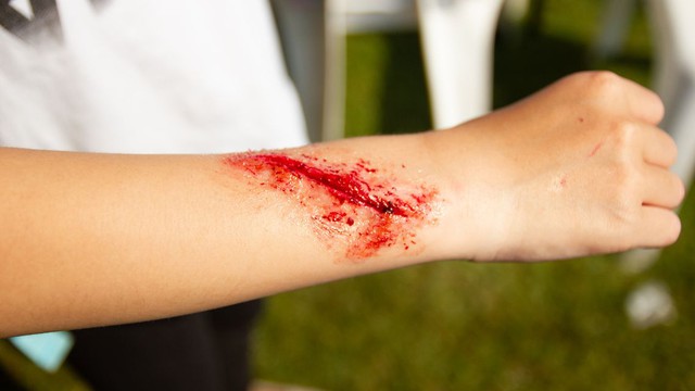 bai-viet/vet-thuong-la-gi-cac-loai-vet-thuong-cach-so-cuu-va-xu-ly-dung-chuan.html