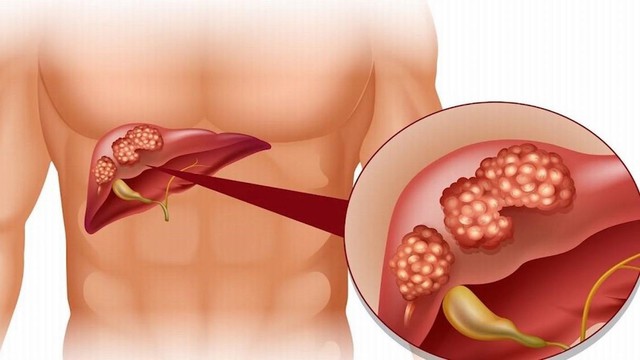 bai-viet/xo-gan-u-mat-nguyen-phat-la-gi-co-nguy-hiem-khong.html