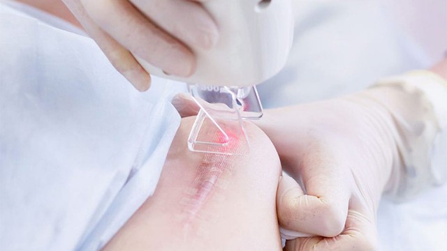 bai-viet/xoa-seo-bang-laser-bao-nhieu-tien-chi-phi-va-loi-ich-cua-phuong-phap-nay.html