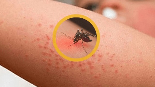 bai-viet/huong-dan-cach-phong-chong-sot-xuat-huyet-cho-tre-khong-phai-ai-cung-biet.html